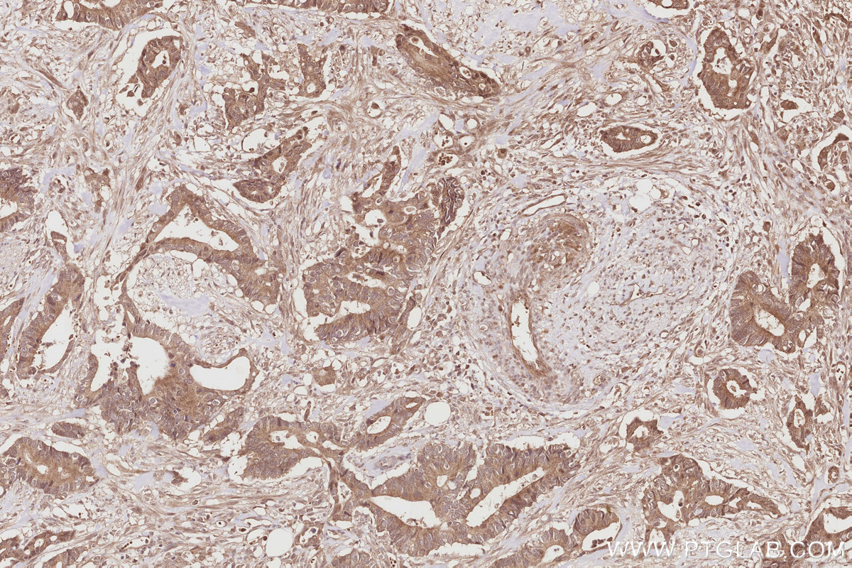 Immunohistochemical analysis of paraffin-embedded human rectal cancer tissue slide using KHC2895 (STRADB IHC Kit).