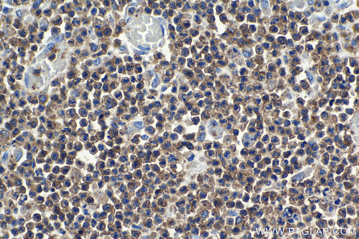 Immunohistochemical analysis of paraffin-embedded human colon cancer tissue slide using KHC1153 (STX11 IHC Kit).