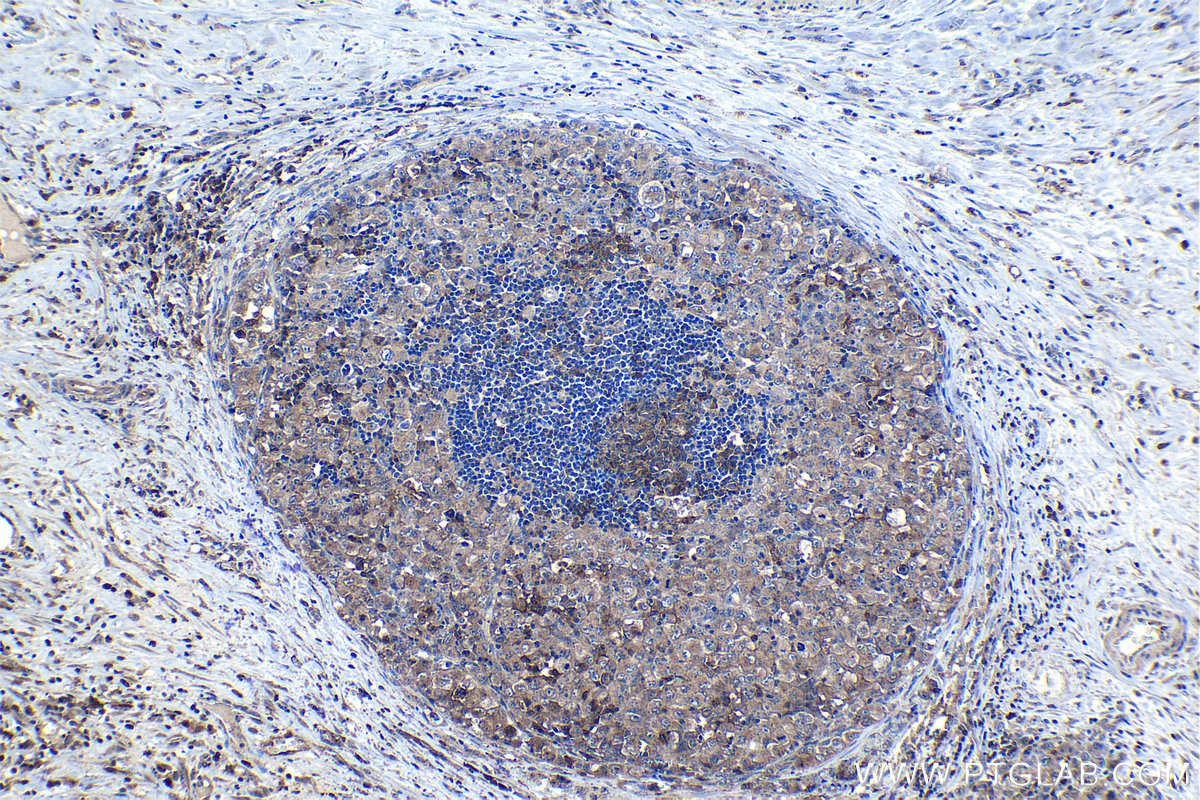 Immunohistochemical analysis of paraffin-embedded human lymphoma tissue slide using KHC1153 (STX11 IHC Kit).