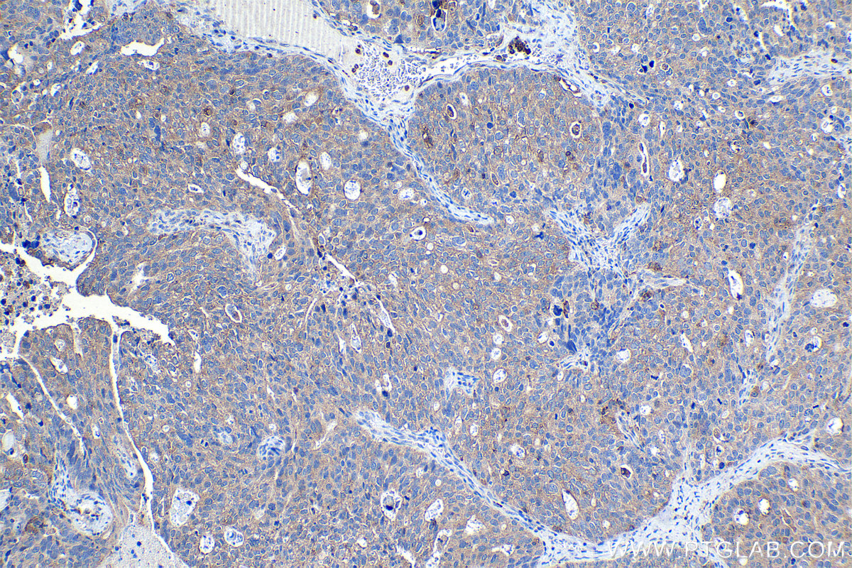Immunohistochemical analysis of paraffin-embedded human ovary tumor tissue slide using KHC1153 (STX11 IHC Kit).