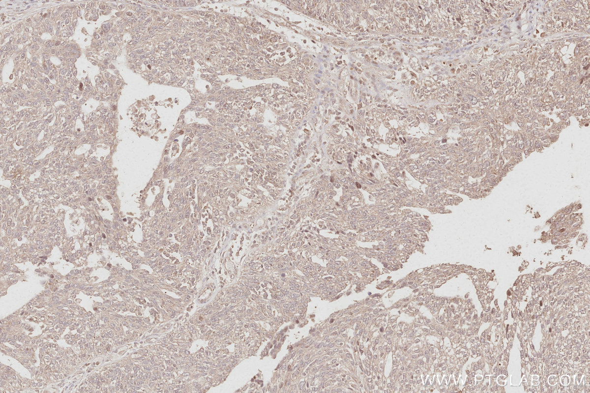 Immunohistochemical analysis of paraffin-embedded human ovary cancer tissue slide using KHC3092 (STYXL1 IHC Kit).