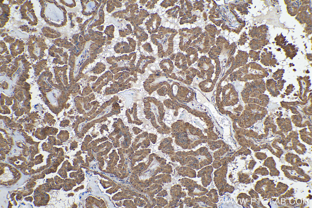 Immunohistochemical analysis of paraffin-embedded human thyroid cancer tissue slide using KHC0851 (SUGT1 IHC Kit).