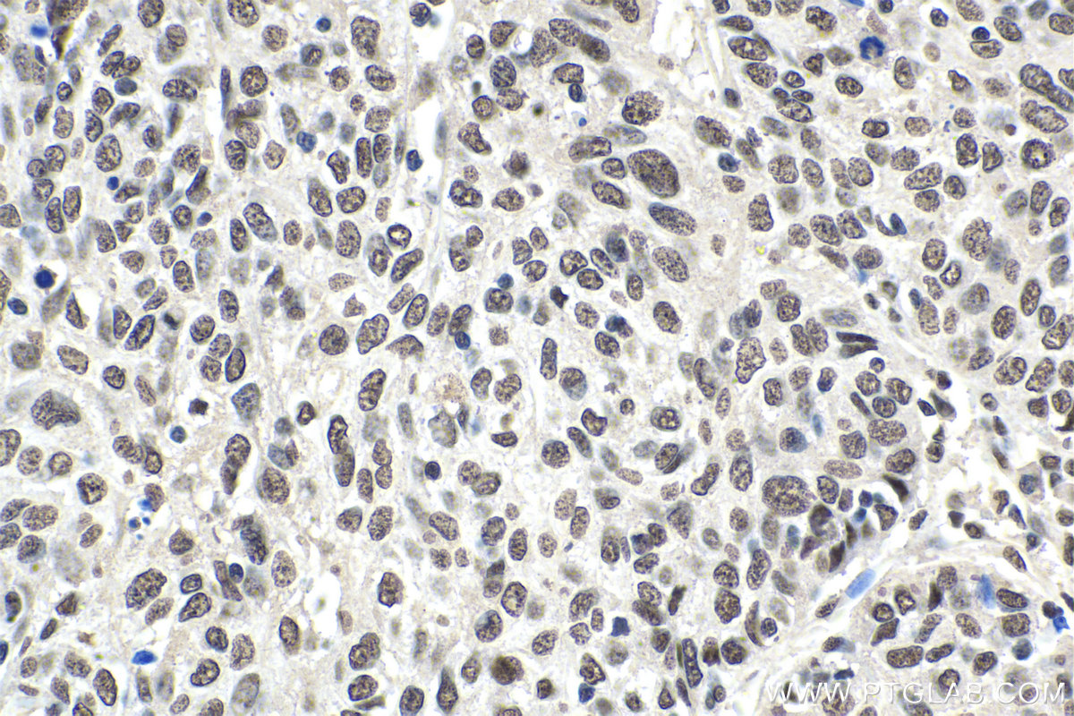Immunohistochemical analysis of paraffin-embedded human cervical cancer tissue slide using KHC1649 (SUMO1 IHC Kit).