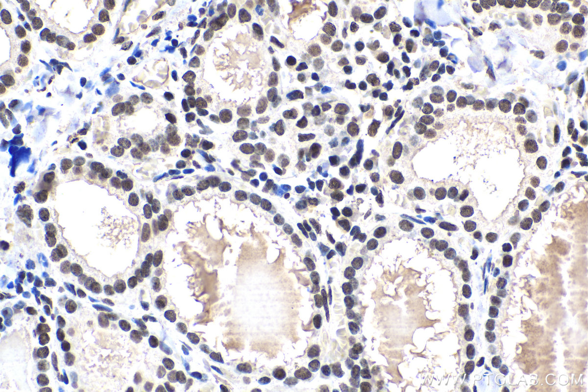 Immunohistochemical analysis of paraffin-embedded human thyroid cancer tissue slide using KHC1649 (SUMO1 IHC Kit).