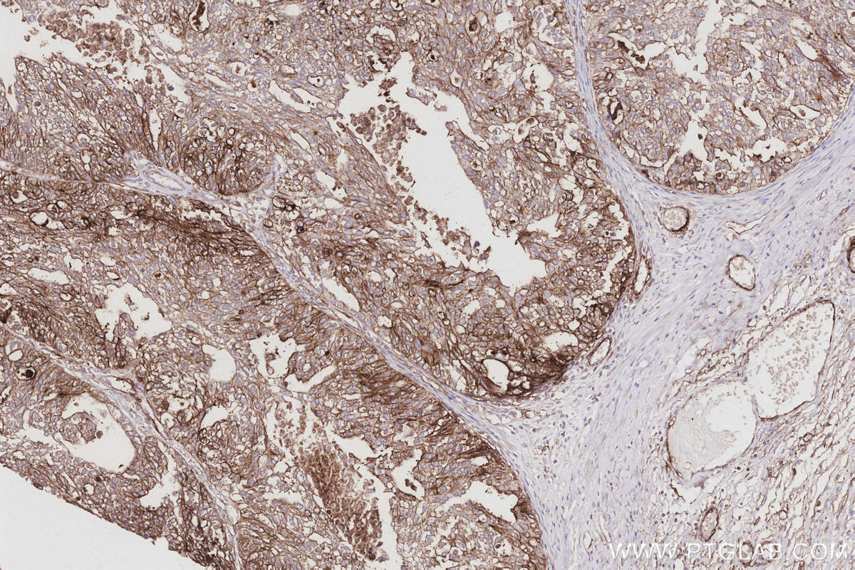 Immunohistochemical analysis of paraffin-embedded human ovary cancer tissue slide using KHC3005 (SUSD2 IHC Kit). Immunohistochemical analysis of paraffin-embedded human ovary cancer tissue slide using KHC3005 (SUSD2 IHC Kit).