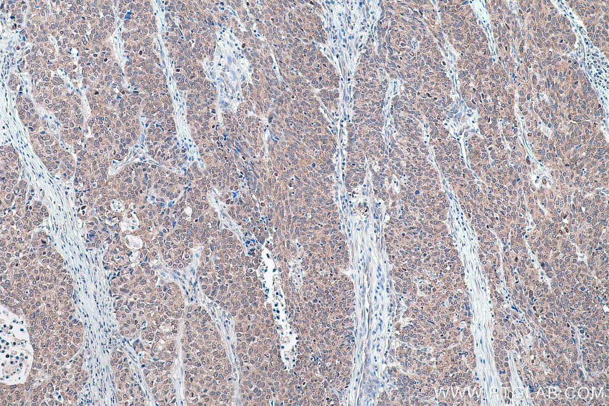 Immunohistochemical analysis of paraffin-embedded human stomach cancer tissue slide using KHC0883 (SYNCRIP IHC Kit).