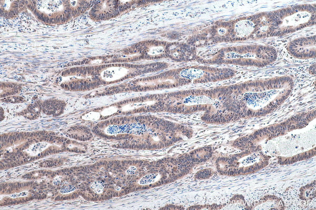 Immunohistochemical analysis of paraffin-embedded human colon cancer tissue slide using KHC0883 (SYNCRIP IHC Kit).