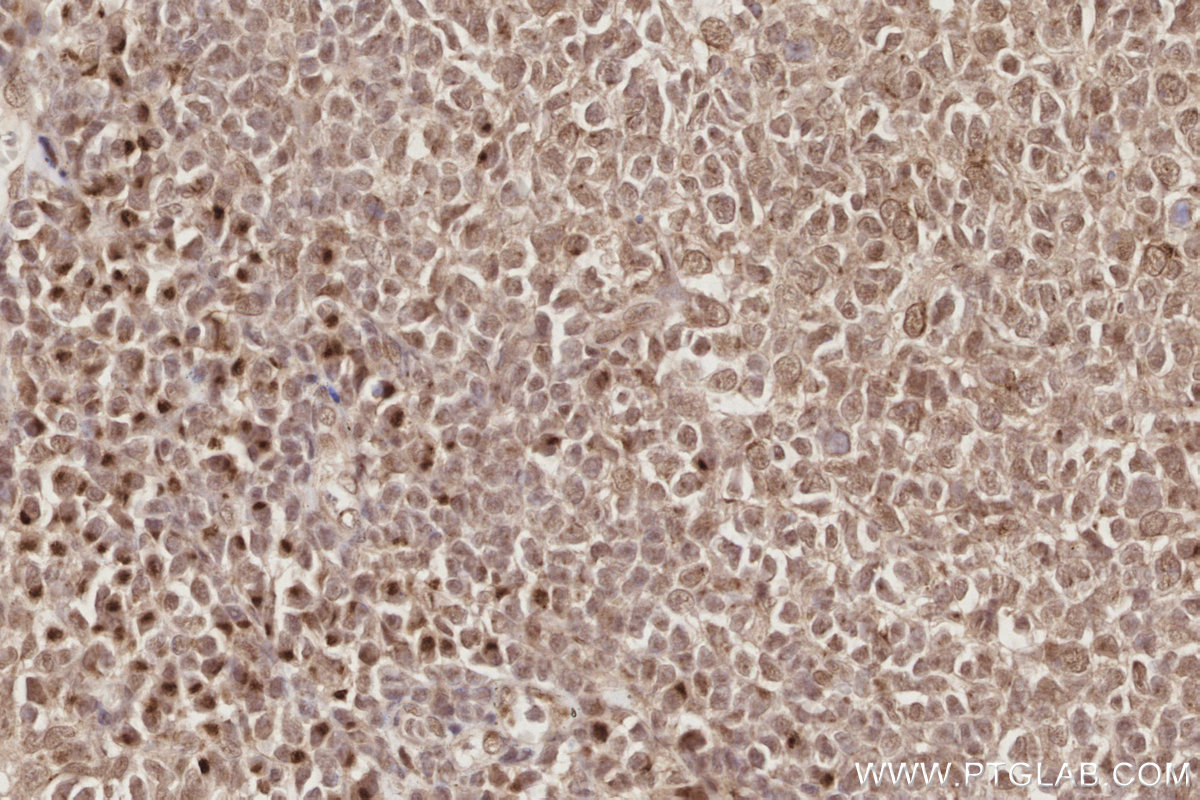 Immunohistochemical analysis of paraffin-embedded human tonsillitis tissue slide using KHC2897 (Spartan IHC Kit). Immunohistochemical analysis of paraffin-embedded human tonsillitis tissue slide using KHC2897 (Spartan IHC Kit).