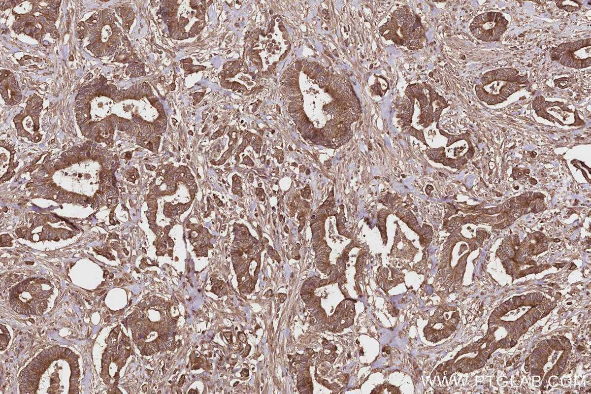 Immunohistochemical analysis of paraffin-embedded human rectal cancer tissue slide using KHC2801 (Syndetin/CCDC132 IHC Kit).