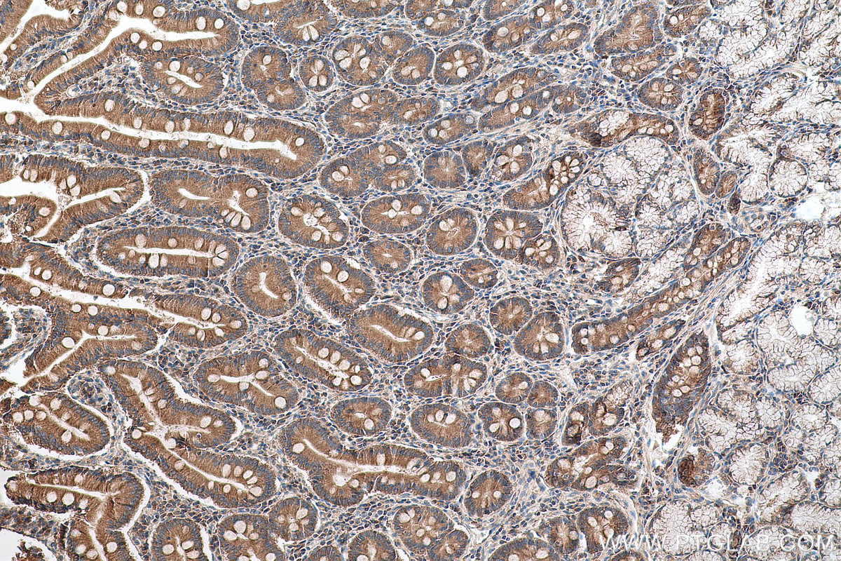 Immunohistochemical analysis of paraffin-embedded human stomach cancer tissue slide using KHC0647 (TACC1 IHC Kit).