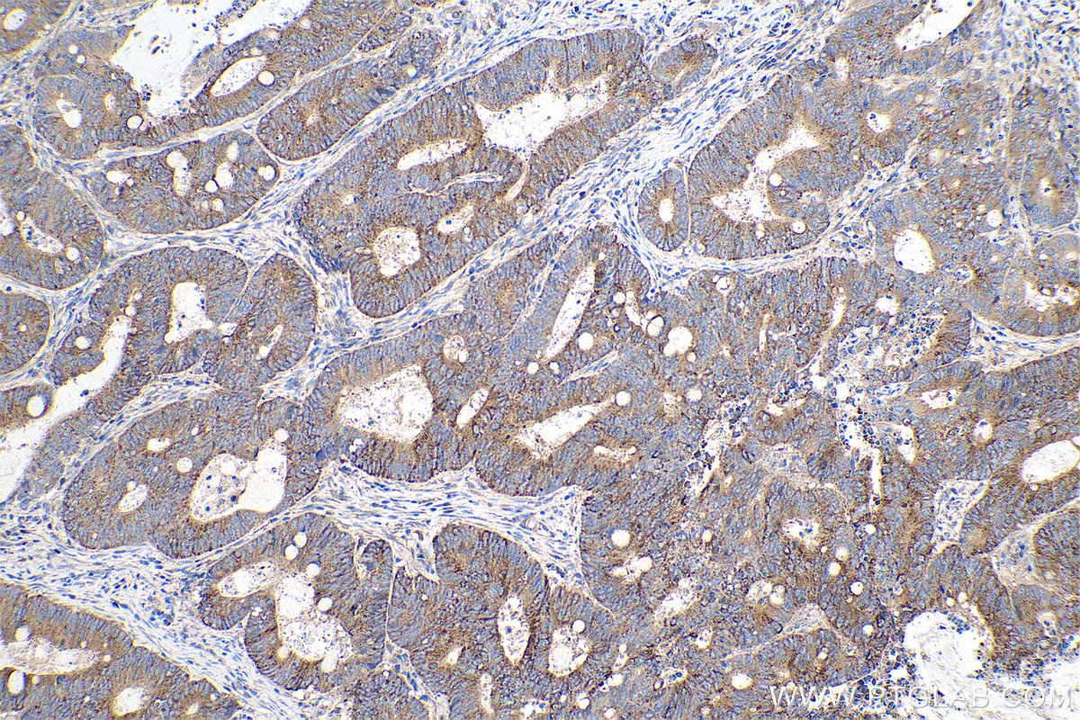 Immunohistochemical analysis of paraffin-embedded human colon cancer tissue slide using KHC0647 (TACC1 IHC Kit).