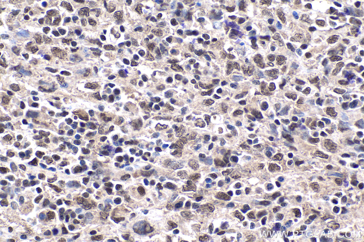 Immunohistochemical analysis of paraffin-embedded human malignant melanoma tissue slide using KHC1858 (TAF15 IHC Kit).