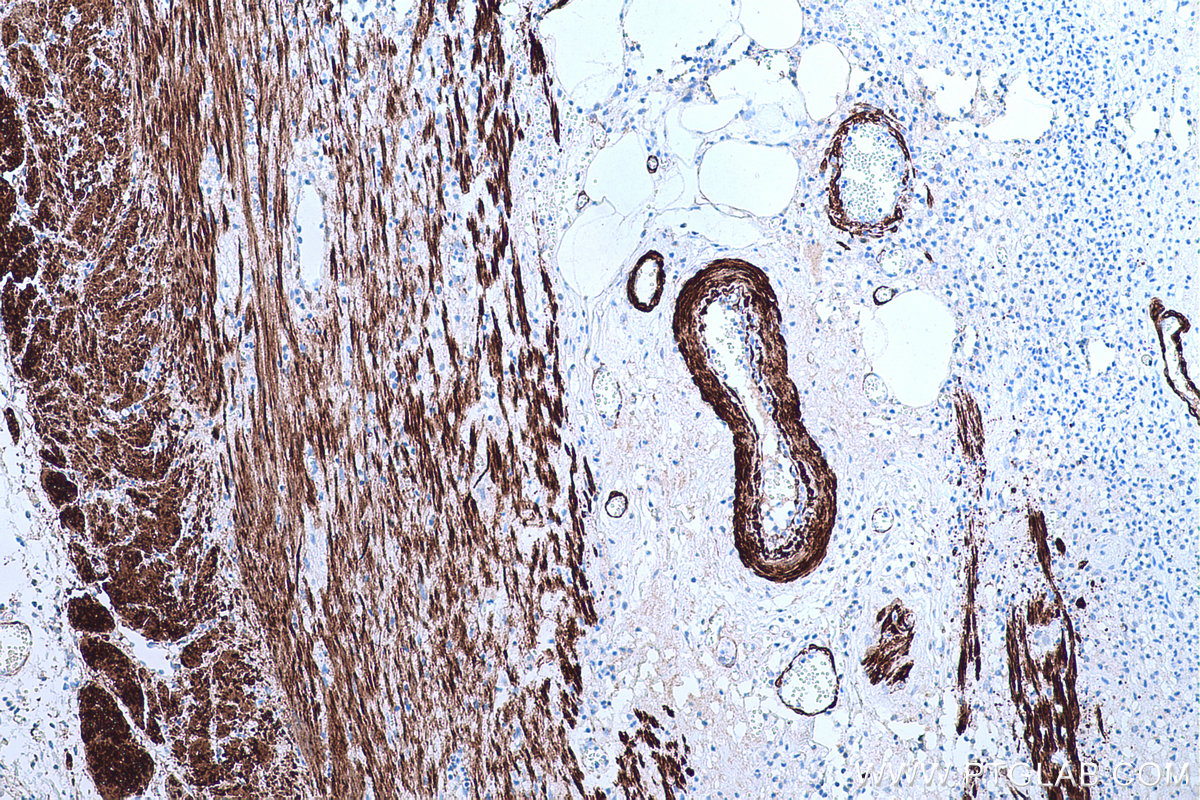 Immunohistochemical analysis of paraffin-embedded human appendicitis tissue slide using KHC0652 (TAGLN IHC Kit).