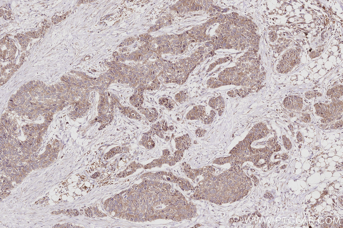 Immunohistochemical analysis of paraffin-embedded human stomach cancer tissue slide using KHC3031 (TAOK2 IHC Kit).