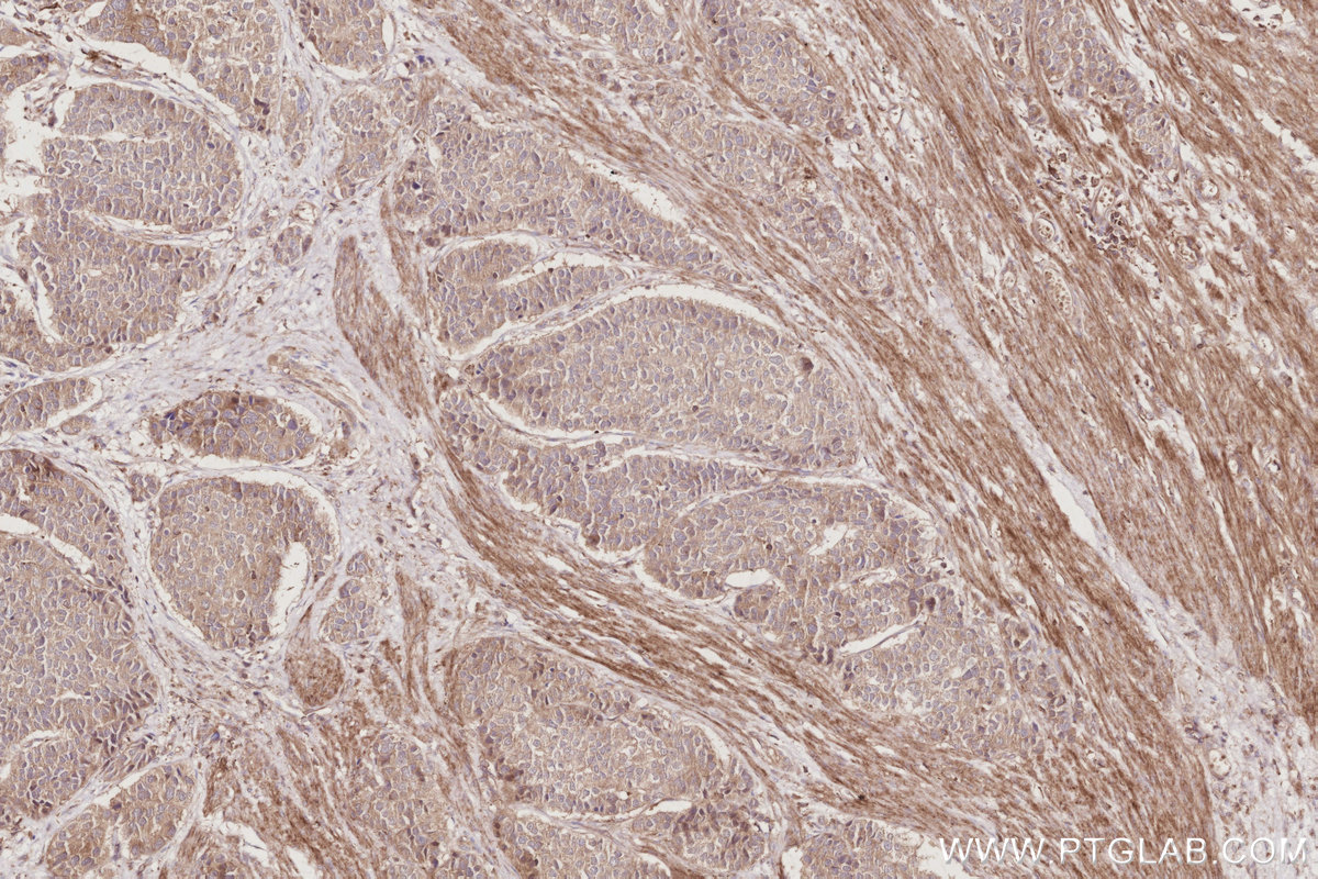 Immunohistochemical analysis of paraffin-embedded human stomach cancer tissue slide using KHC2908 (TAOK3 IHC Kit).