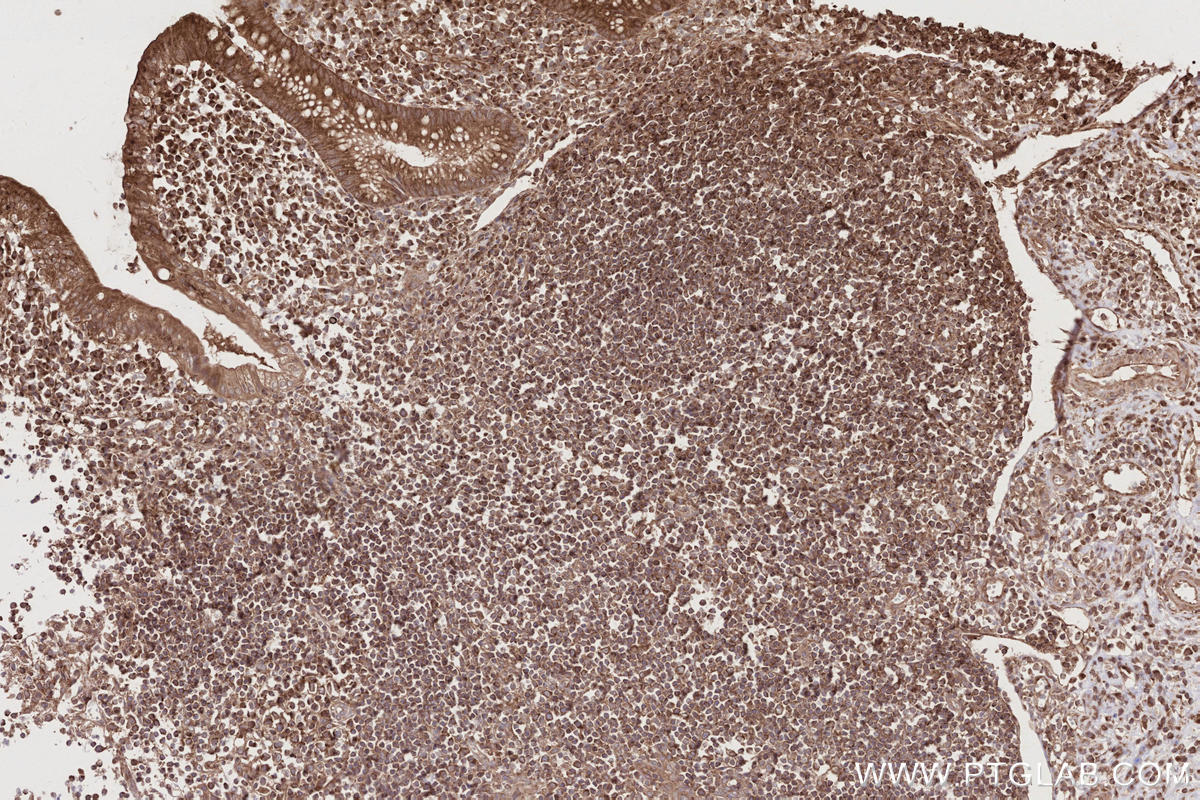 Immunohistochemical analysis of paraffin-embedded human appendicitis tissue slide using KHC2711 (TBC1D15 IHC Kit).