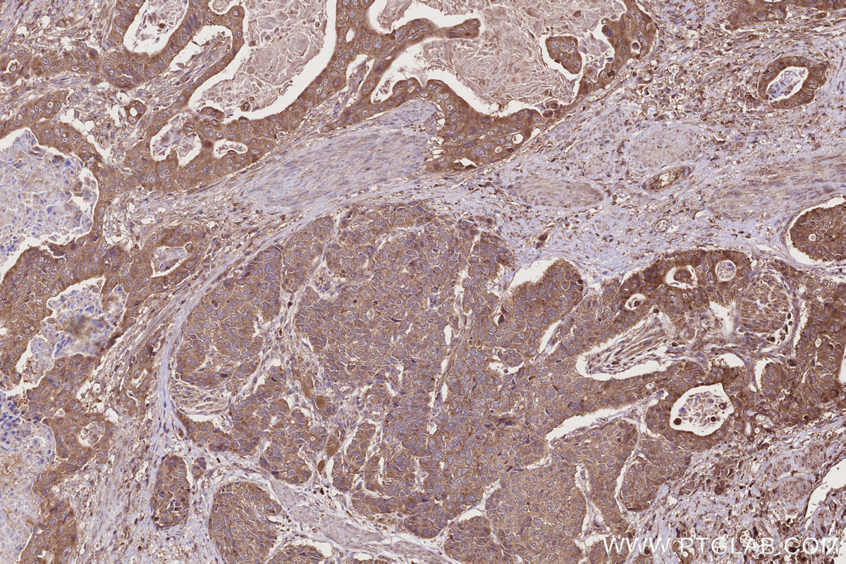 Immunohistochemical analysis of paraffin-embedded human stomach cancer tissue slide using KHC2711 (TBC1D15 IHC Kit).