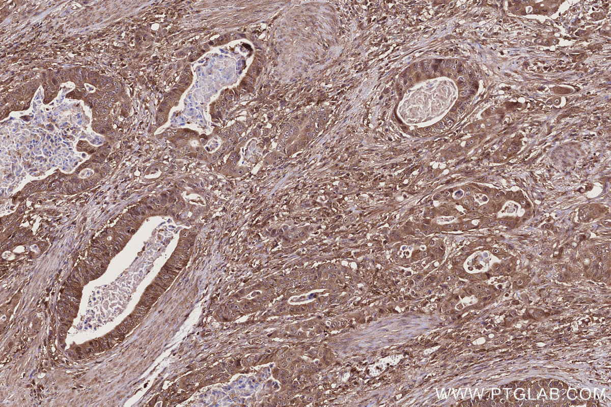Immunohistochemical analysis of paraffin-embedded human stomach cancer tissue slide using KHC2748 (TBC1D5 IHC Kit).