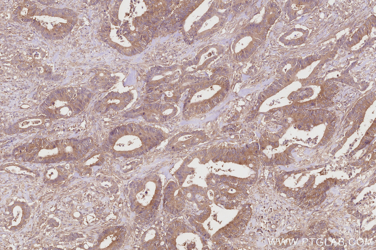Immunohistochemical analysis of paraffin-embedded human rectal cancer tissue slide using KHC2868 (TBCD IHC Kit).