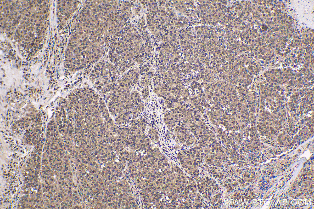 Immunohistochemical analysis of paraffin-embedded human stomach cancer tissue slide using KHC1647 (TBPL1 IHC Kit).