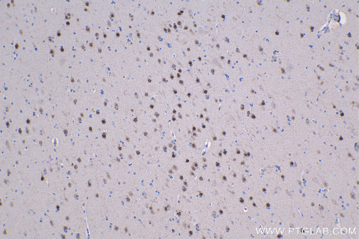 Immunohistochemical analysis of paraffin-embedded human gliomas tissue slide using KHC1338 (TBR1 IHC Kit).