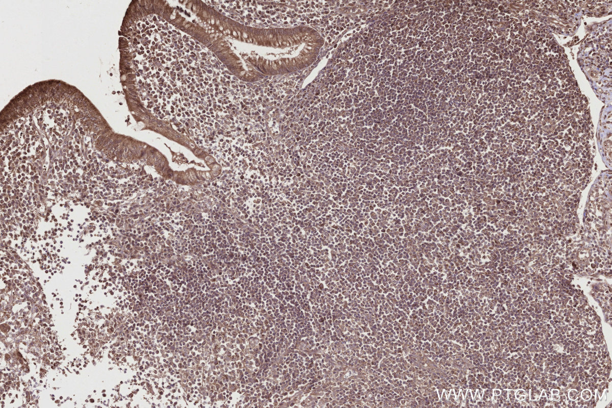 Immunohistochemical analysis of paraffin-embedded human appendicitis tissue slide using KHC2774 (TBRG4 IHC Kit).