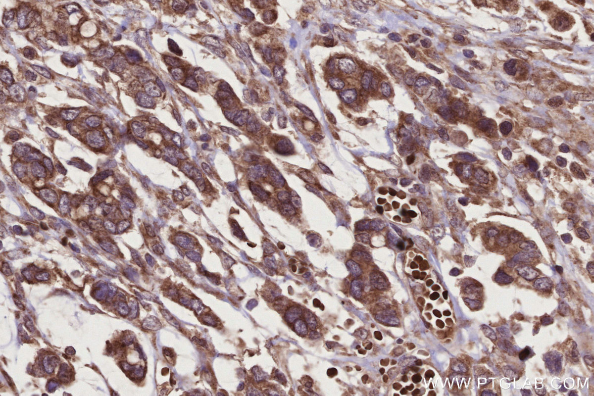 Immunohistochemical analysis of paraffin-embedded human stomach cancer tissue slide using KHC2774 (TBRG4 IHC Kit).