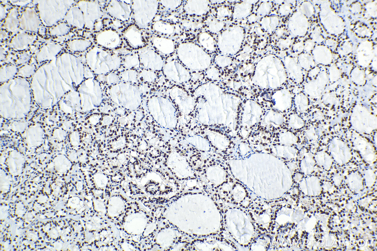 Immunohistochemical analysis of paraffin-embedded human thyroid cancer tissue slide using KHC1559 (TCEA1 IHC Kit).