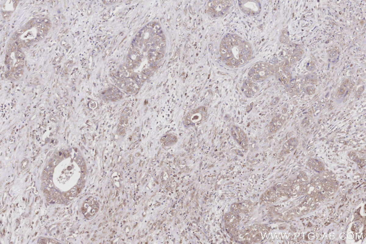 Immunohistochemical analysis of paraffin-embedded human pancreas cancer tissue slide using KHC3195 (TCP1 IHC Kit).