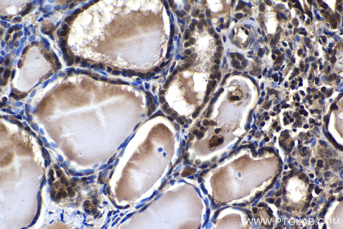 Immunohistochemical analysis of paraffin-embedded human thyroid cancer tissue slide using KHC1495 (TDP2 IHC Kit).