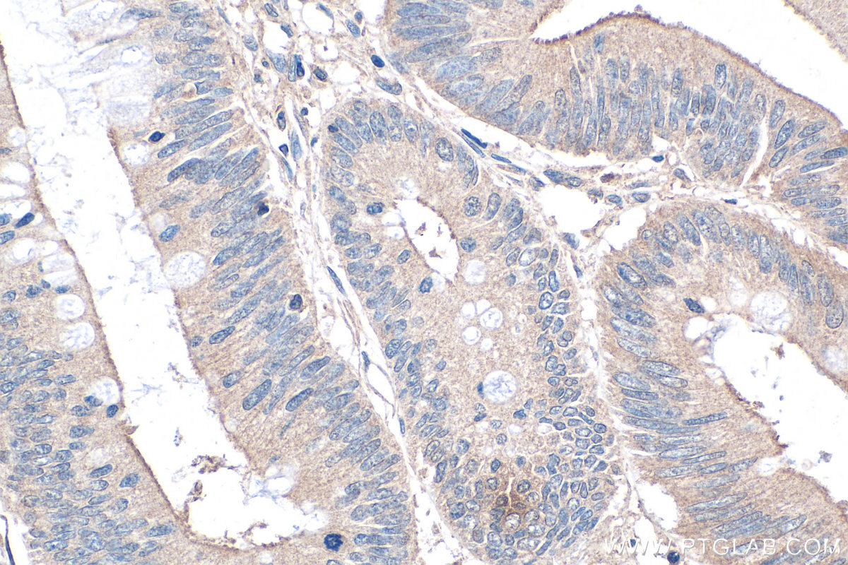 Immunohistochemical analysis of paraffin-embedded human colon cancer tissue slide using KHC0131 (TGF beta 1 IHC Kit).