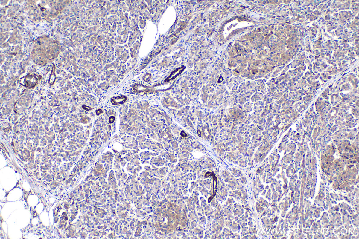 Immunohistochemical analysis of paraffin-embedded human pancreas cancer tissue slide using KHC1453 (TGFB1I1/HIC5 IHC Kit).