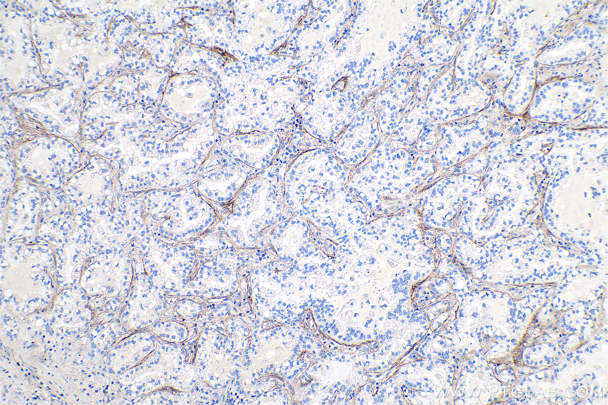 Immunohistochemical analysis of paraffin-embedded human lung cancer tissue slide using KHC0729 (TGFBI IHC Kit).