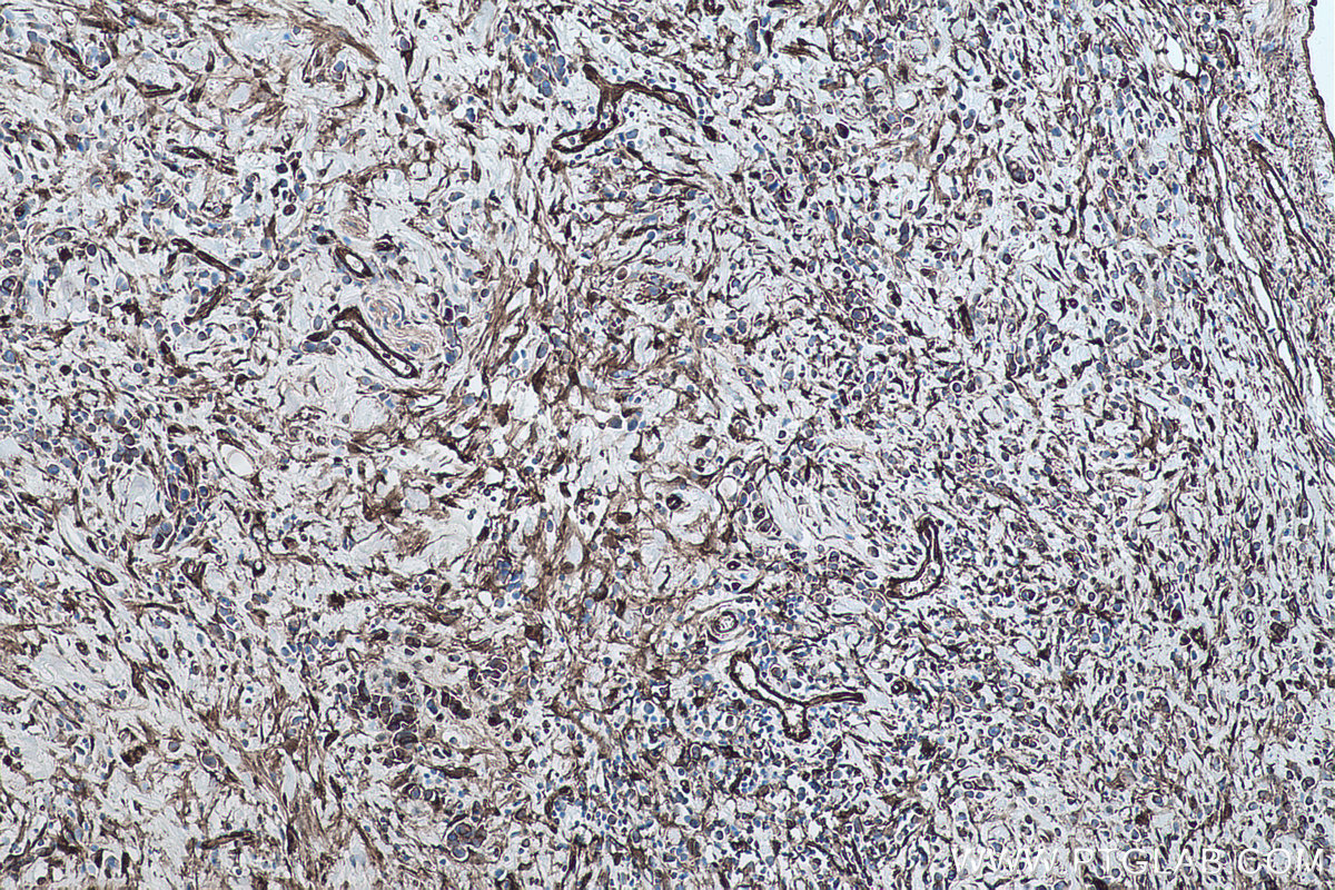 Immunohistochemical analysis of paraffin-embedded human stomach cancer tissue slide using KHC0467 (TGM2 IHC Kit).