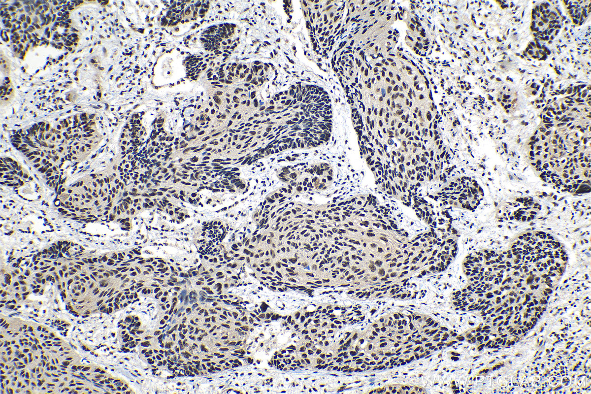 Immunohistochemical analysis of paraffin-embedded human lung cancer tissue slide using KHC1300 (THOC1 IHC Kit).