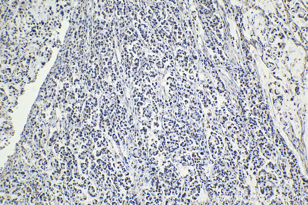 Immunohistochemical analysis of paraffin-embedded human colon cancer tissue slide using KHC1043 (THRAP3 IHC Kit).