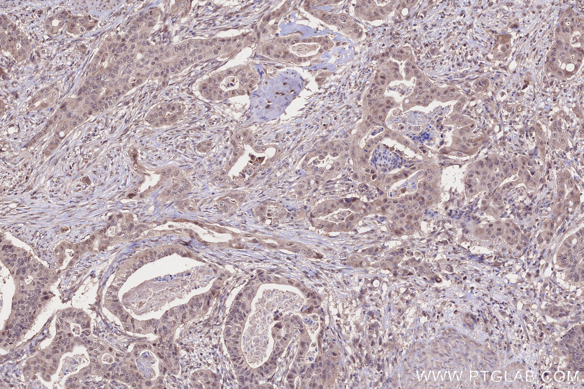 Immunohistochemical analysis of paraffin-embedded human stomach cancer tissue slide using KHC2645 (TIAM2 IHC Kit).