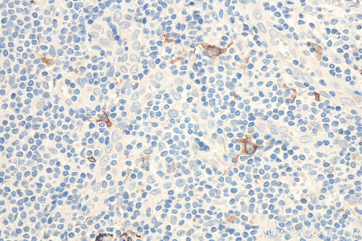 Immunohistochemical analysis of paraffin-embedded human lung cancer tissue slide using KHC0495 (TIMD4 IHC Kit).