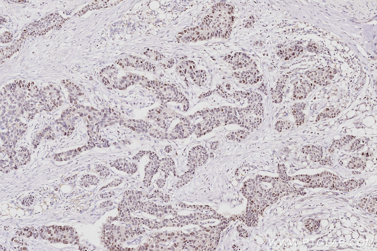 Immunohistochemical analysis of paraffin-embedded human stomach cancer tissue slide using KHC3044 (TIMELESS IHC Kit). Immunohistochemical analysis of paraffin-embedded human stomach cancer tissue slide using KHC3044 (TIMELESS IHC Kit).