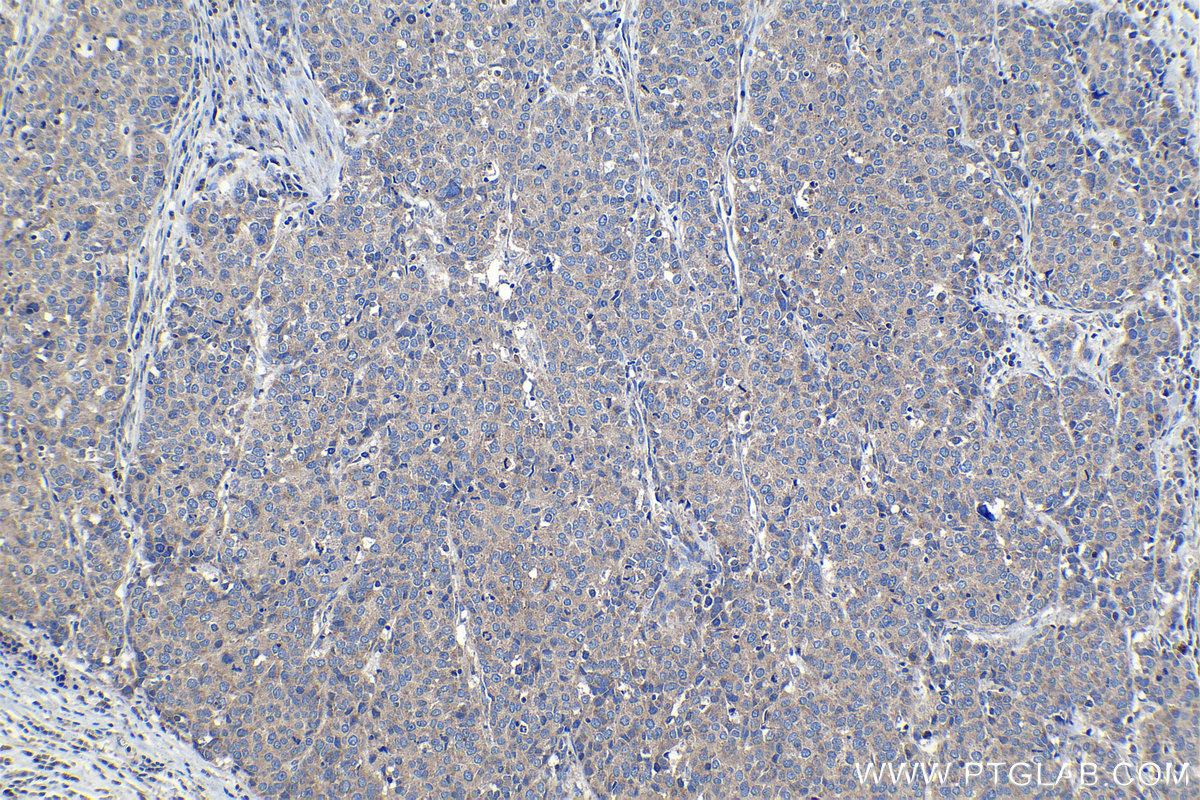 Immunohistochemical analysis of paraffin-embedded human stomach cancer tissue slide using KHC1185 (TIMM17A IHC Kit).