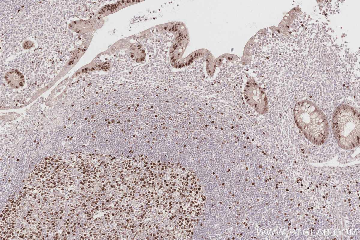 Immunohistochemical analysis of paraffin-embedded human appendicitis tissue slide using KHC2875 (TIPIN IHC Kit).