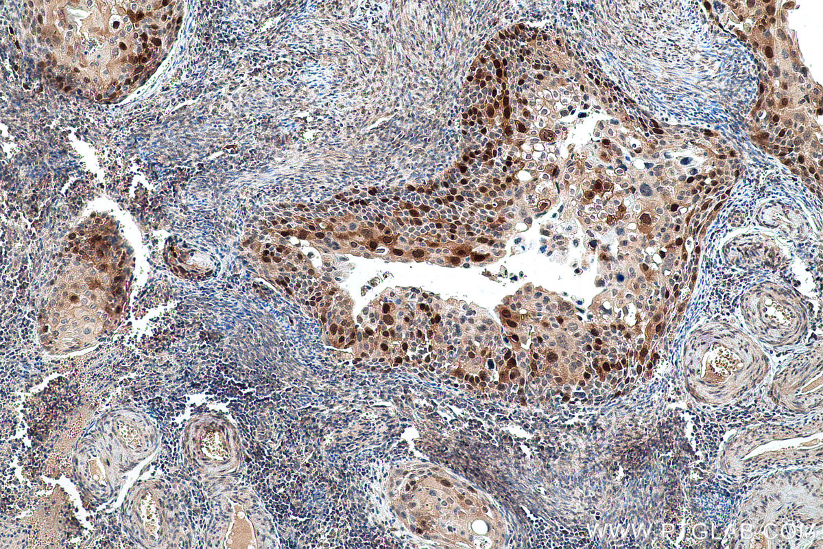 Immunohistochemical analysis of paraffin-embedded human cervical cancer tissue slide using KHC0765 (TK1 IHC Kit).