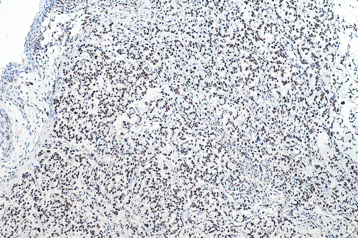 Immunohistochemical analysis of paraffin-embedded human colon cancer tissue slide using KHC0672 (TKT IHC Kit).