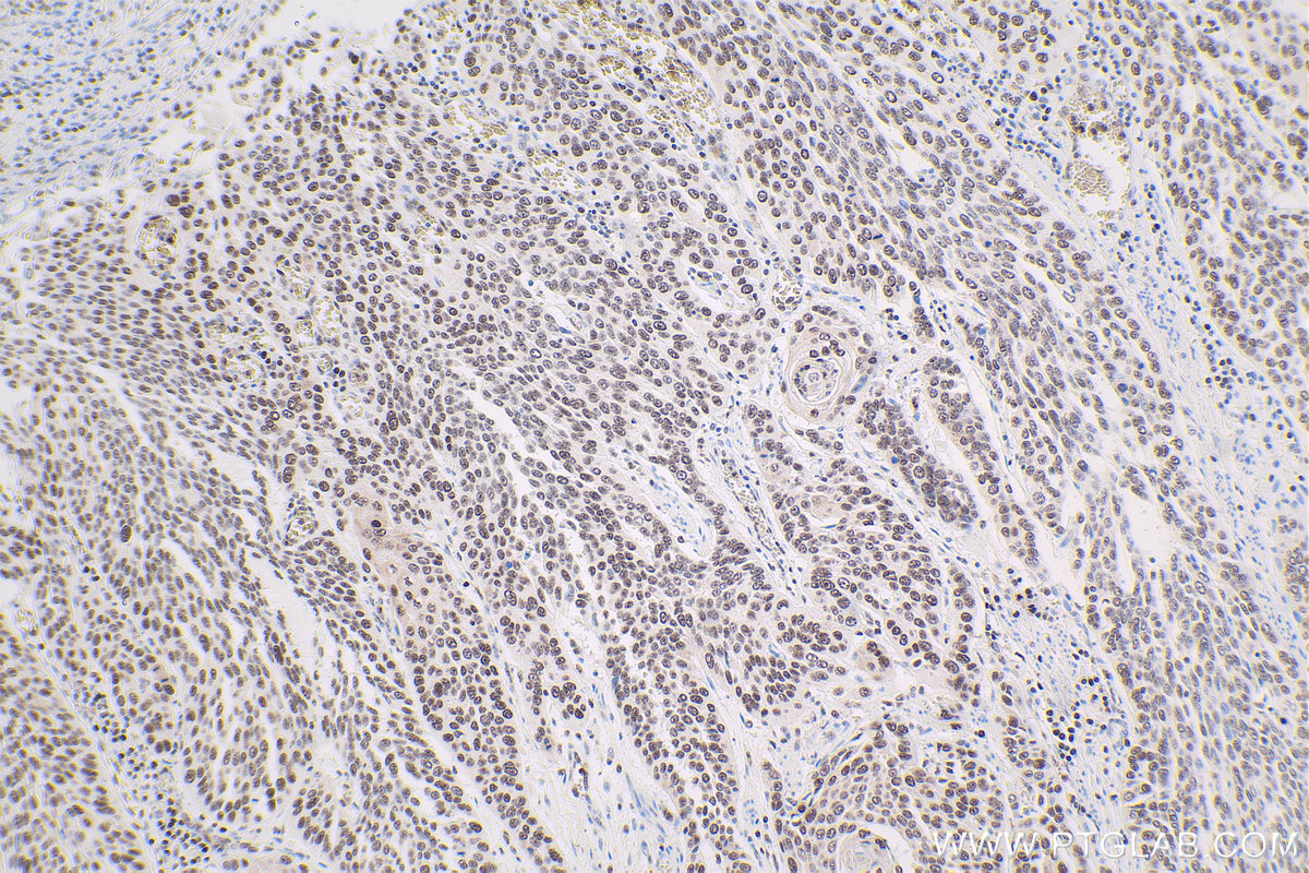 Immunohistochemical analysis of paraffin-embedded human oesophagus cancer tissue slide using KHC1673 (TLE3 IHC Kit).
