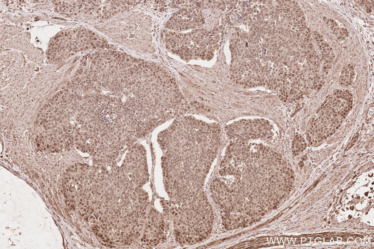 Immunohistochemical analysis of paraffin-embedded human stomach cancer tissue slide using KHC2634 (TLK2 IHC Kit).