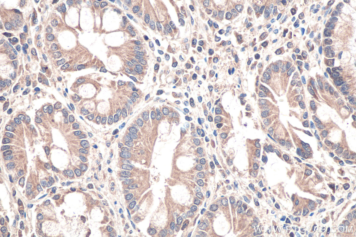 Immunohistochemical analysis of paraffin-embedded human stomach cancer tissue slide using KHC0650 (TMEFF2 IHC Kit).