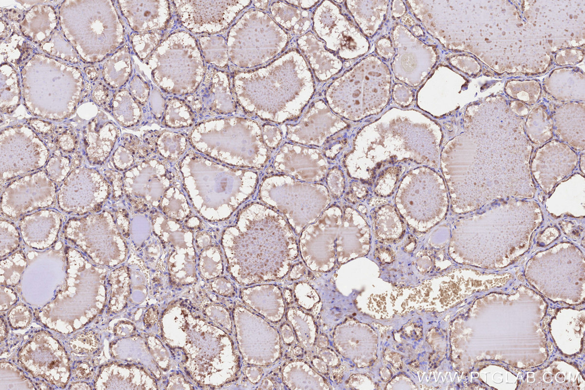Immunohistochemical analysis of paraffin-embedded human thyroid cancer tissue slide using KHC3236 (TMEM258 IHC Kit). Immunohistochemical analysis of paraffin-embedded human thyroid cancer tissue slide using KHC3236 (TMEM258 IHC Kit).