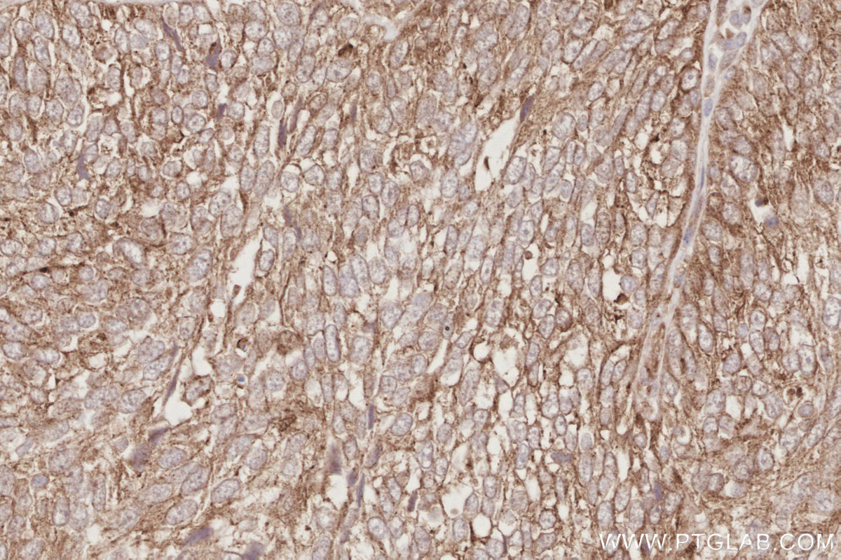 Immunohistochemical analysis of paraffin-embedded human ovary cancer tissue slide using KHC2882 (TMEM59 IHC Kit).