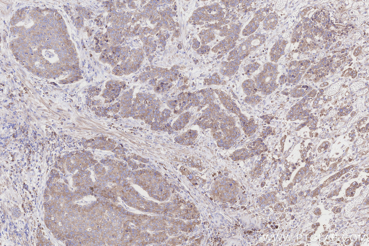 Immunohistochemical analysis of paraffin-embedded human stomach cancer tissue slide using KHC3262 (TMEM85 IHC Kit).