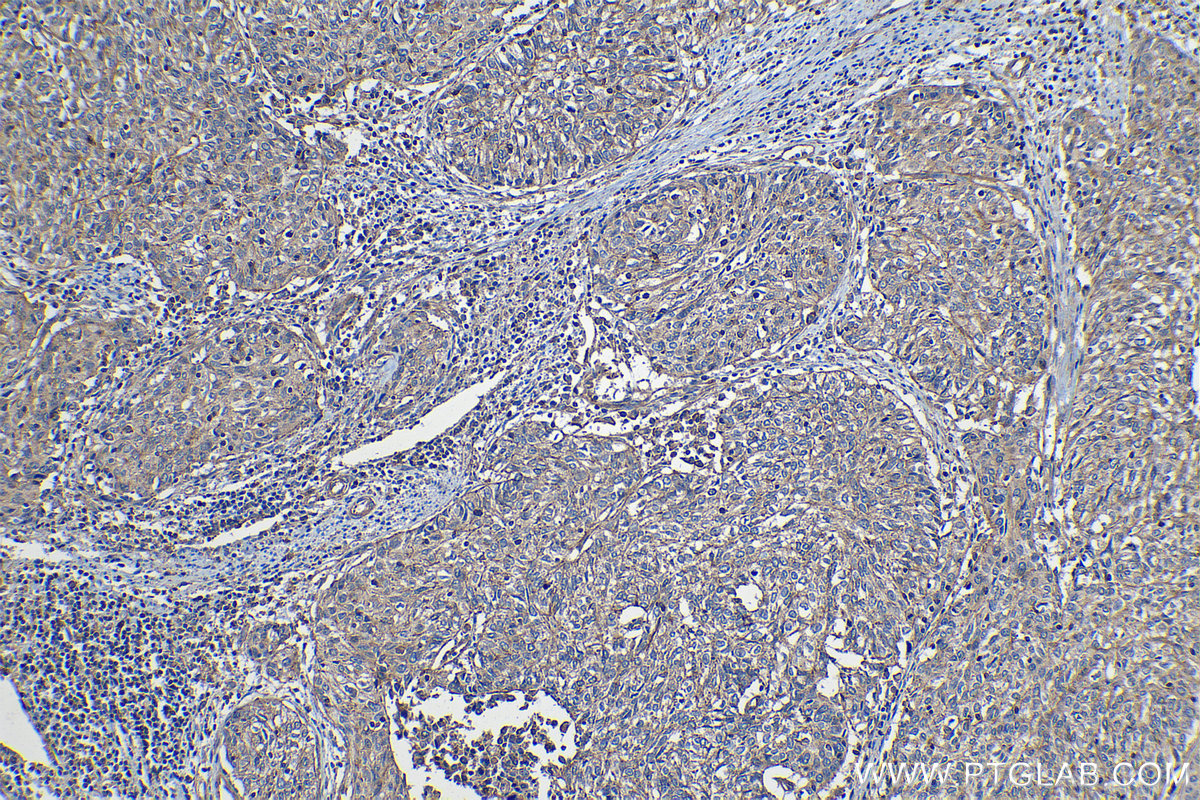 Immunohistochemical analysis of paraffin-embedded human cervical cancer tissue slide using KHC1244 (TMOD3 IHC Kit).